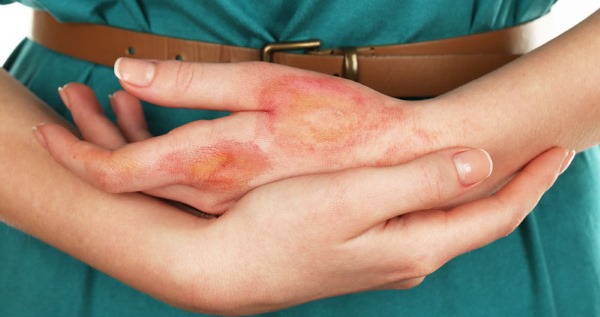 Украинцы стали больше страдать аллергией из-за войны и выбросов, - эксперт Фото: иллюстративное