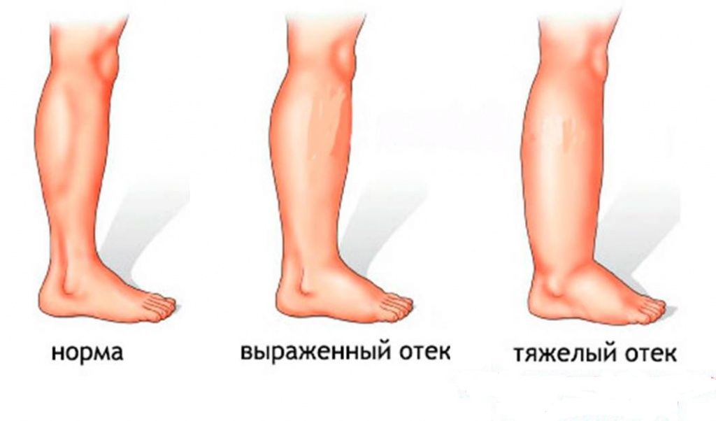 Как отличить нормальные отеки от патологических