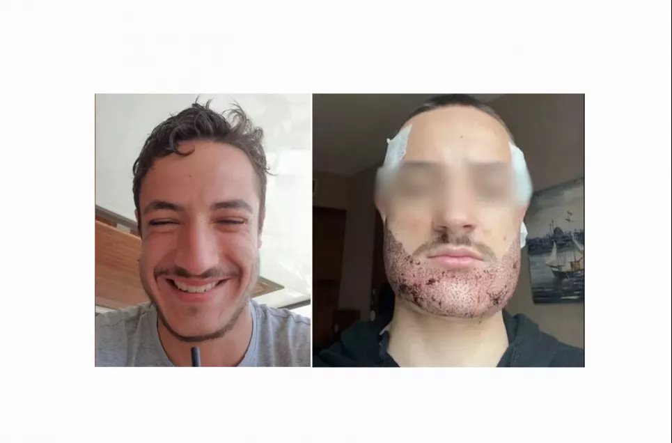 Француз покончил с собой после неудачной пересадки бороды «агентом по недвижимости, который выдавал себя за хирурга» Матье Вижье Латур до и после неудачной пересадки волос в Стамбуле. Фото: Daily Telegraph