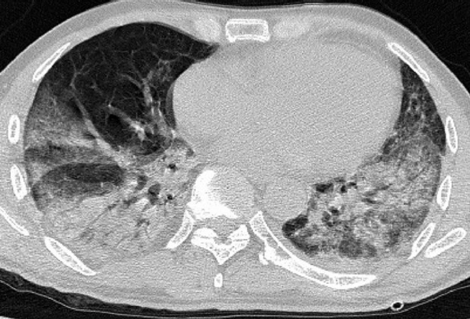 Знімки легень у пацієнтів з Китаю: патологія очевидна Фото: pubs.rsna.org