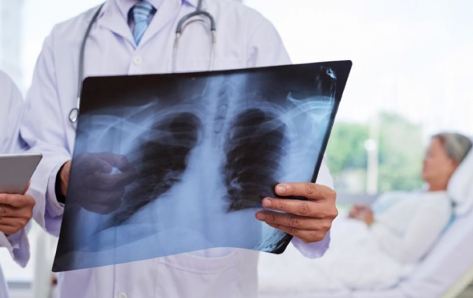 Пневмонію не можна лікувати лише таблетками — лікар  Фото ілюстративне