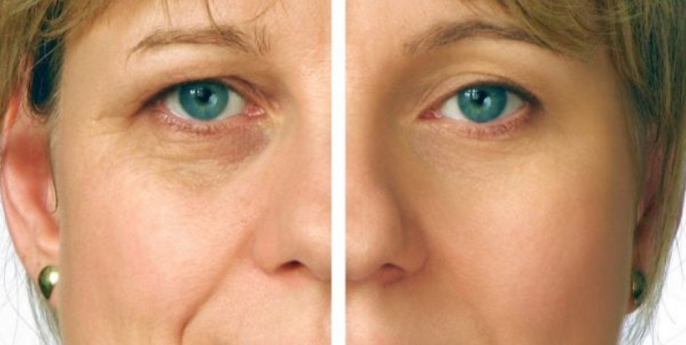 Темні кола під очима? Обов’язково перевірте своє здоров’я