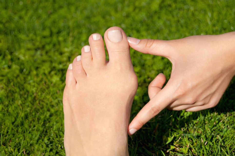 Лікарі назвали три ефективні способи, які позбавлять «кісточки» на нозі
