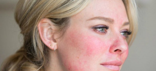 Який стан шкіри говорить про приховані хвороби