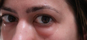 Симптомом яких хвороб можуть бути набряки на обличчі та під очима