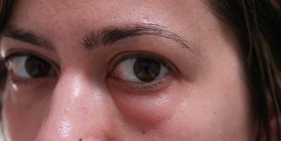 Симптомом яких хвороб можуть бути набряки на обличчі та під очима