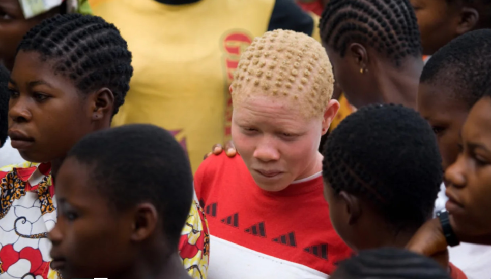 Зачем в Африке охотятся на людей-альбиносов и как их защитить