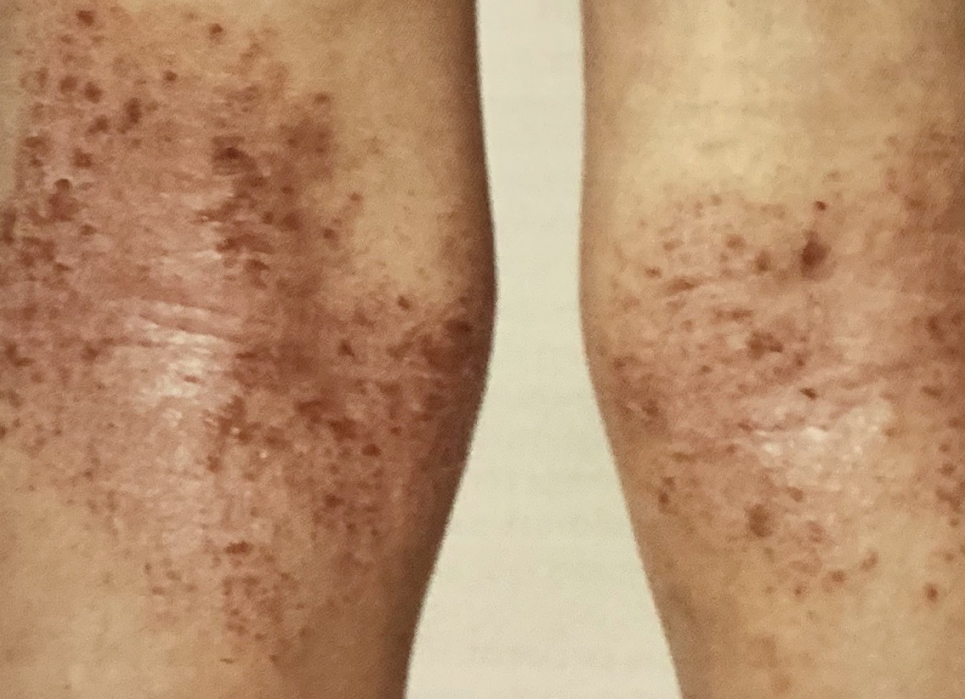 Атопічна екзема: коли з’являється і куди з нею звертатися