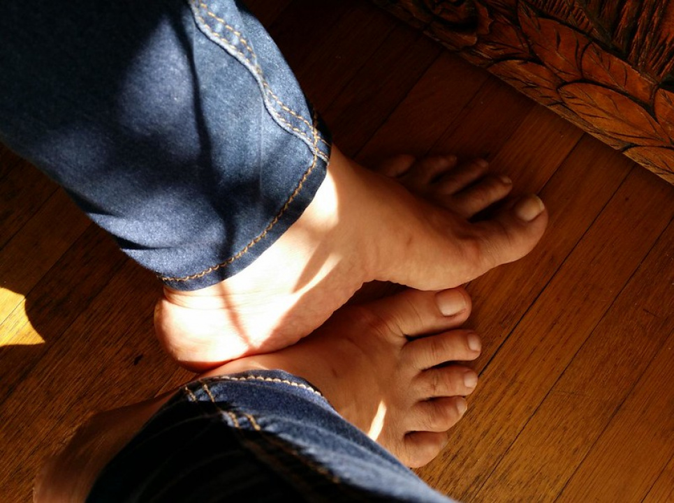 Лікар назвав 5 симптомів, які свідчать про варикозне розширення вен