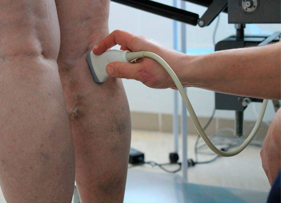 Як зрозуміти, чи є у вас варикоз: флеболог називає чотири ознаки