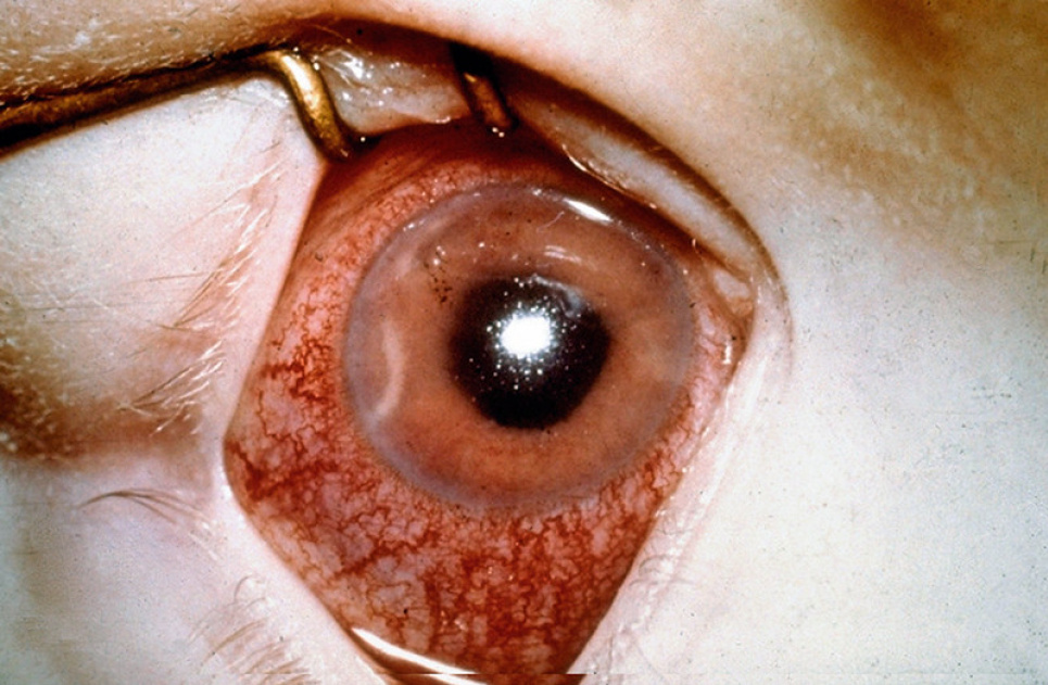 Щоб запобігти глаукомі, потрібно читати й займатися рукоділлям — офтальмолог