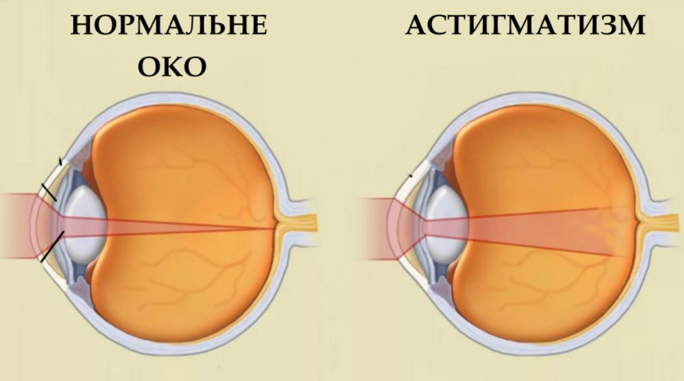 Астигматизм: що це таке і як його діагностувати в домашніх умовах