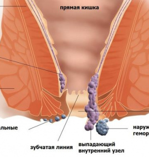 Названі звички, які призводять до появи геморою