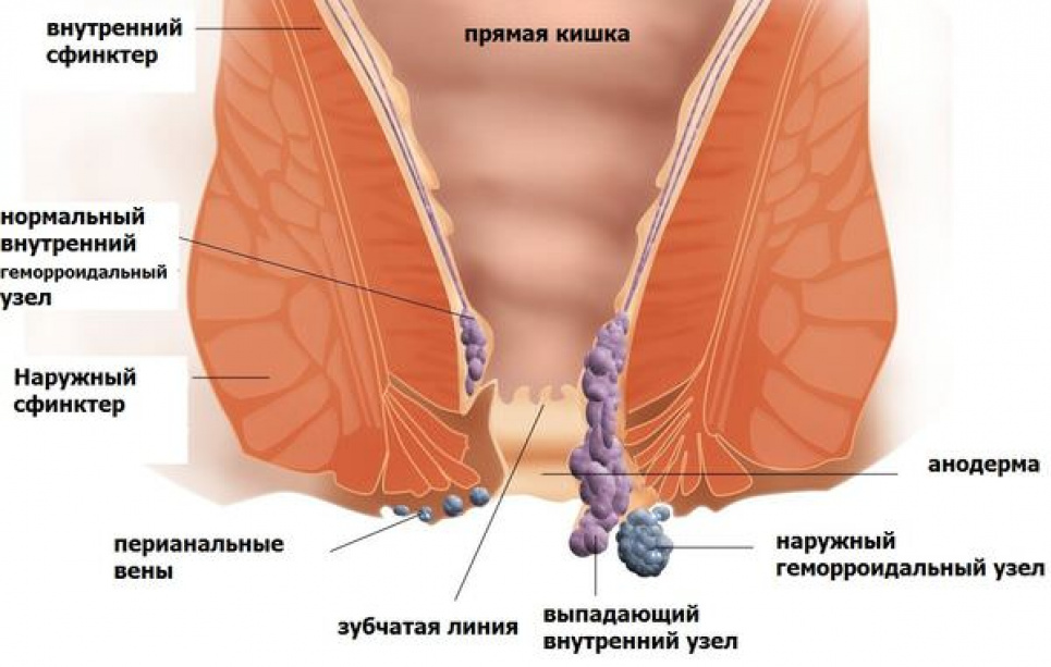 Названі звички, які призводять до появи геморою