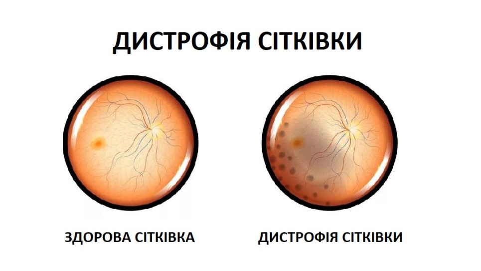 Дистрофія сітківки: як підтримувати зір