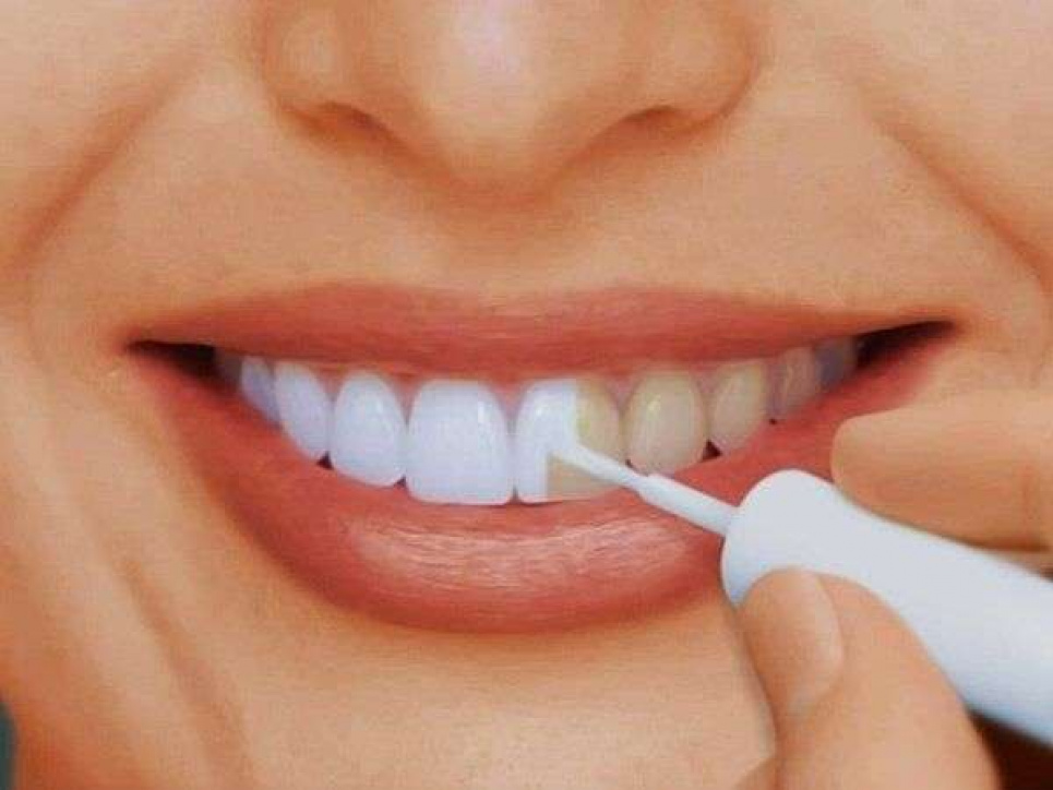 Поради відповідального стоматолога щодо видалення емалі