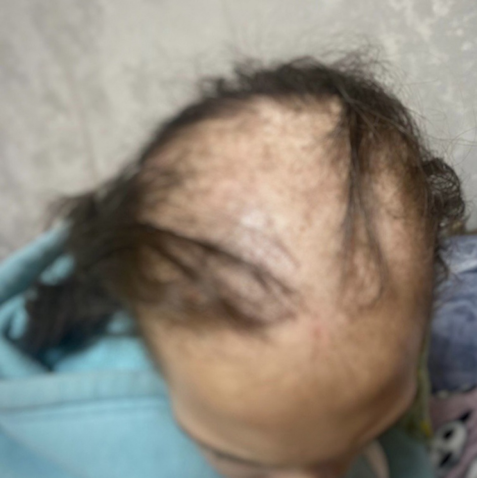 Виявився смачним:сестри-близнючки втратили волосся через надлишок вітаміну А(ФОТО)