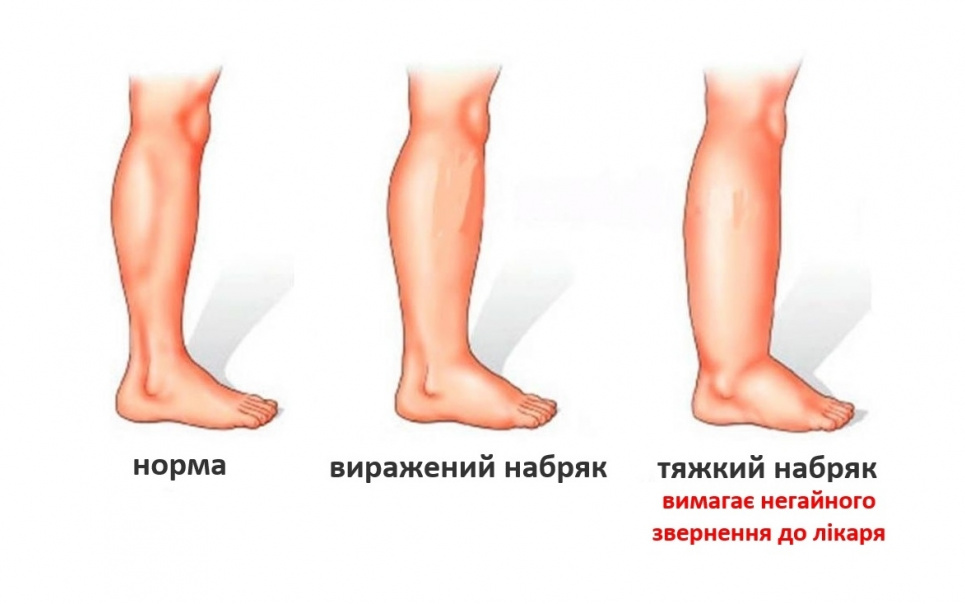Як швидко позбутися набряків: радять реабілітологи