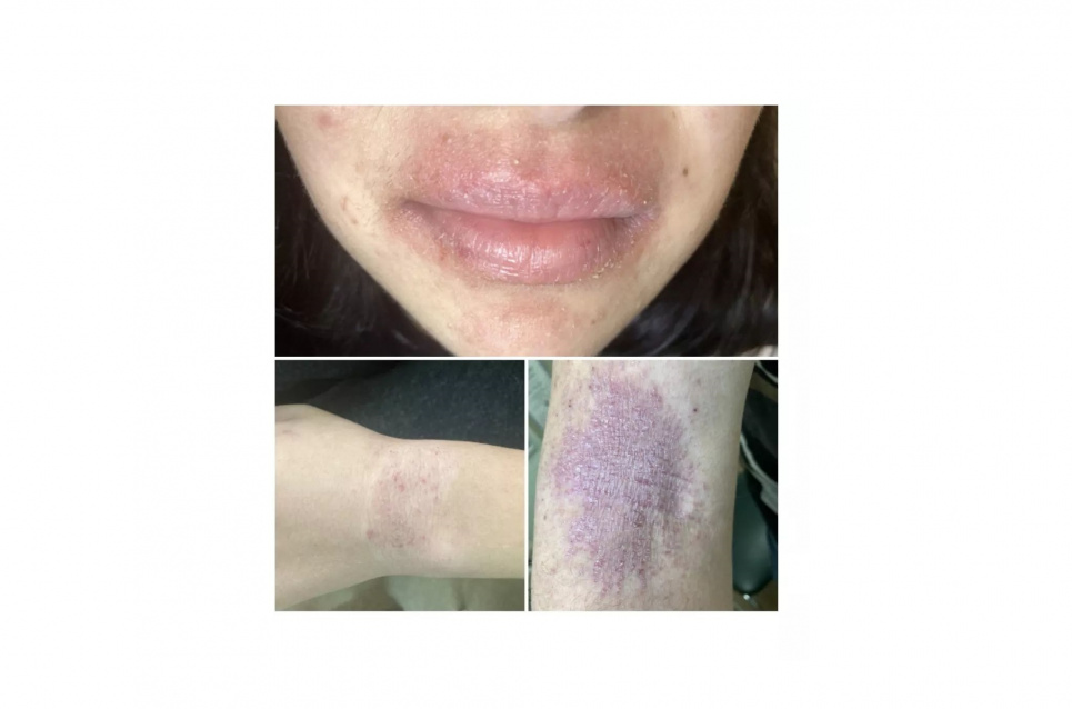 За останні 30 років кількість випадків зросла на 200-300 % — сьогодні відзначають Всесвітній день атопічної екземи Фото: лікар-дерматолог Юлія Пушкар