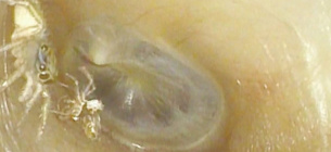 Маленький павук у слуховому проході 64-річної жінки поруч із викинутим екзоскелетом. Фото: Медичний журнал Нової Англії