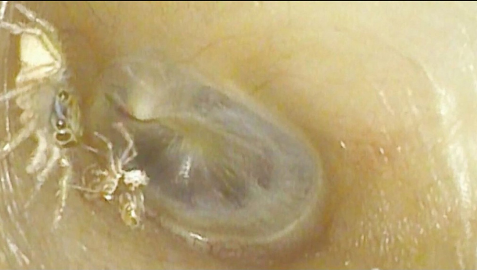 Маленький павук у слуховому проході 64-річної жінки поруч із викинутим екзоскелетом. Фото: Медичний журнал Нової Англії
