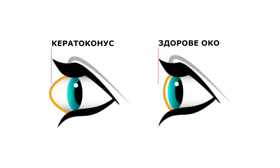 Відсутність лікування може призвести до втрати зору: сьогодні Всесвітній день кератоконуса