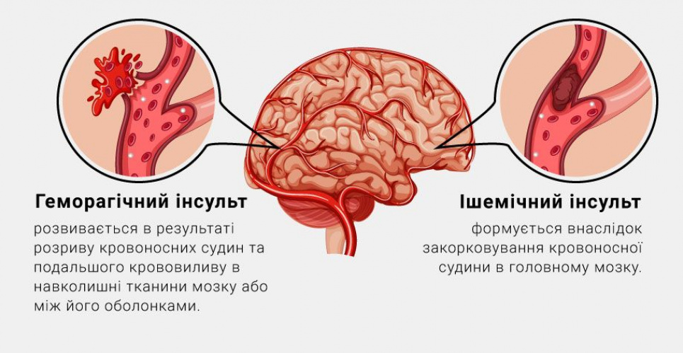  Звичка, яка збільшує ризик інсульту на 30%