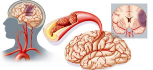 Всесвітній день боротьби з інсультом 29 жовтня: причини, типи, профілактика та реабілітація