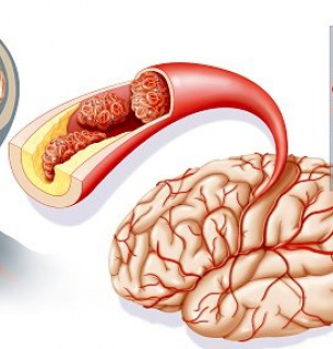 Всемирный день борьбы с инсультом 29 октября: причины, типы, профилактика и реабилитация