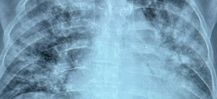 Тяжке ураження легень у хворої 35 років із коінфекцією — грип і COVID-19. Смерть на 8-й день захворювання. Фото: Ольга Голубовська