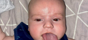 Хірурги зменшили язик малюку Аномалія Охматдит