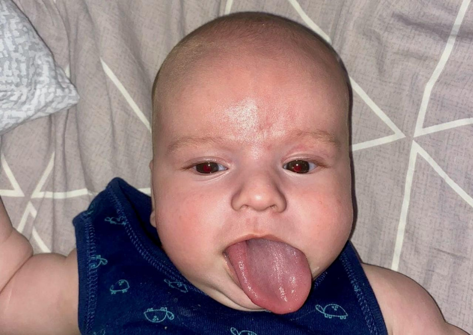 Хирурги уменьшили язык малышу Аномалия Охматдет