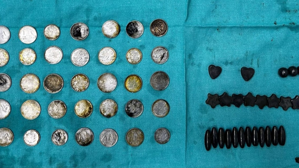 Из кишечника делийца хирурги извлекли 39 монет и 37 магнитов 