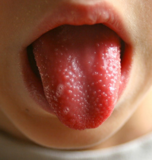 Випадок скарлатини на Одещині