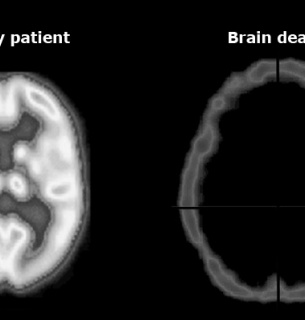 Порядок констатації смерті мозку людини 