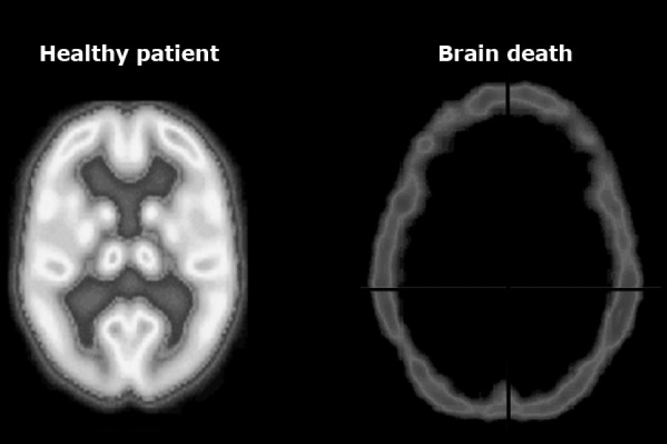 Порядок констатації смерті мозку людини 
