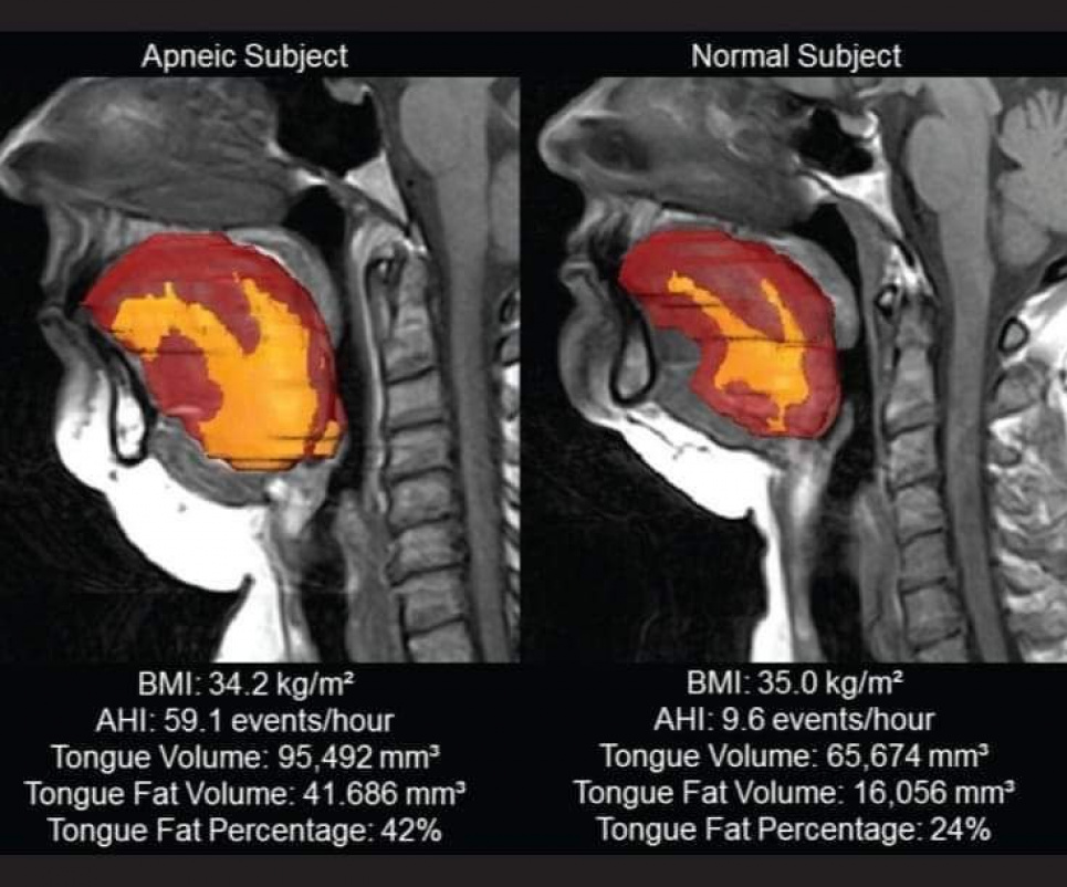 Схожі ІМТ, але різна тяжкість апное