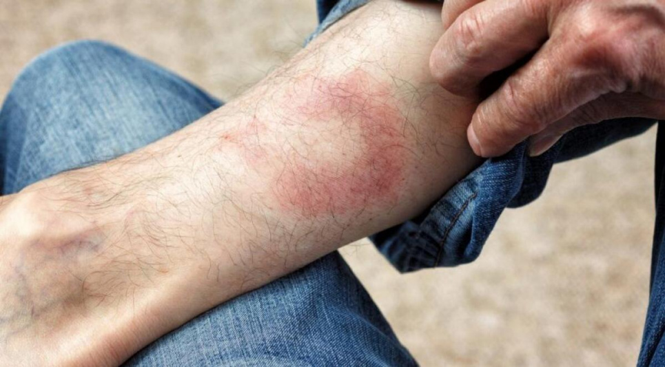 У майже 30 жителів Рівненщини з початку року виявили хворобу Лайма Захворювання на хворобу Лайма