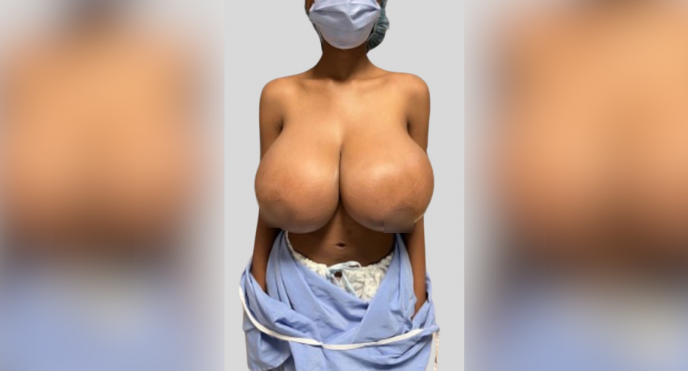 Pfizer boob job: у 19-річної дівчини після вакцинації проти COVID-19 груди збільшилися на п’ять розмірів Фото: PubMed