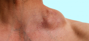 Фото: Apollohospitals.com