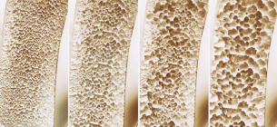 Всемирный день профилактики остеопороза — 20 октября: сохрани движение, сохрани кости. Фото: Shutterstock