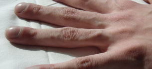 Європейський день муковісцидозу 2025 — підвищення обізнаності. Фото: Jerry Nick, M.D.