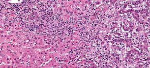 Внутрипеченочная холангиокарцинома. Гистология. Изображение из открытых источников