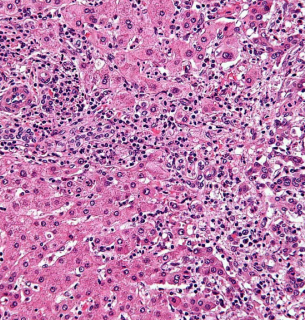 Внутрипеченочная холангиокарцинома. Гистология. Изображение из открытых источников