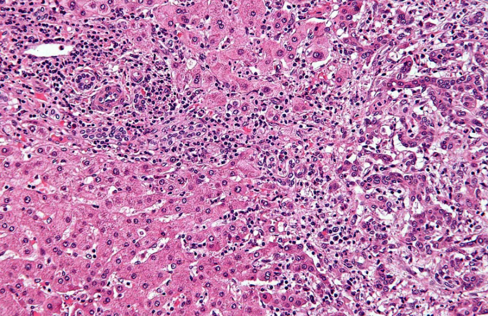 Внутрішньопечінкова холангіокарцинома. Гістологія. Зображення з відкритих джерел