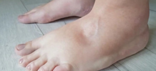 Всемирный день борьбы с лимфедемой 6 марта: факты и советы