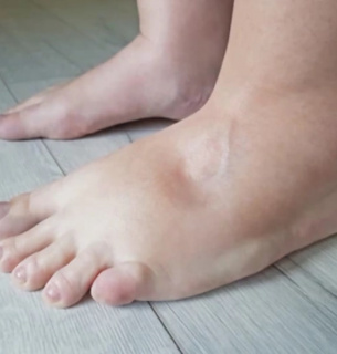 Всесвітній день боротьби з лімфедемою 6 березня: факти та поради