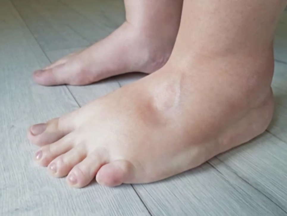 Всесвітній день боротьби з лімфедемою 6 березня: факти та поради