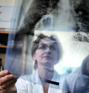 Всемирный день борьбы с туберкулезом: симптомы, лечение и роль фтизиатра